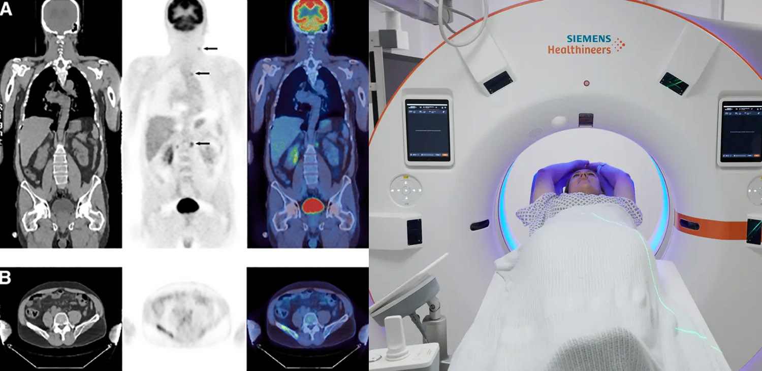 IMA-petct